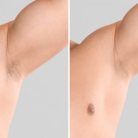 Brown Black And White Minimalist Laser Hair Removal Photo Collage Instagram Story (Instagram Post)